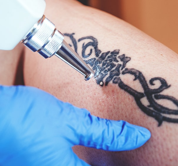 Tattoo Removal Laser