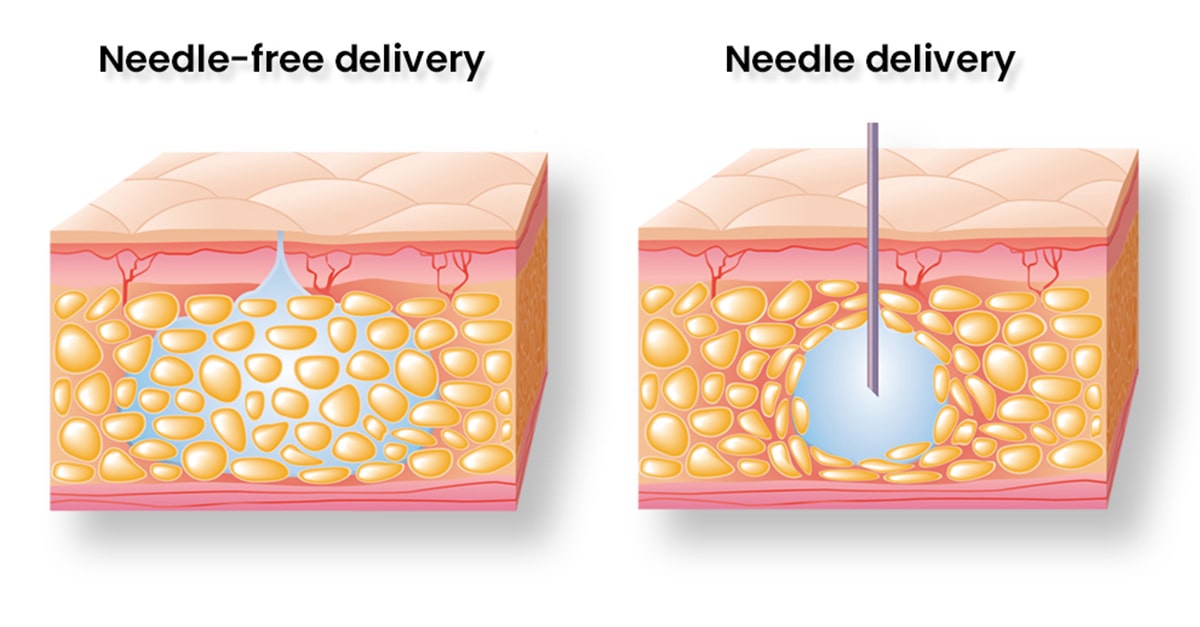 Needle free delivery vs needle delivery